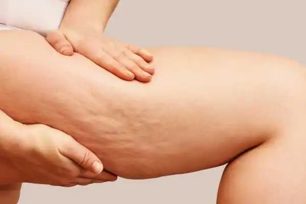 Image of woman showing leg with cellulite Hassocks
