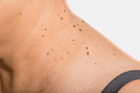 Are you looking for easy skin tag removal Hassocks - then contact Spire today!