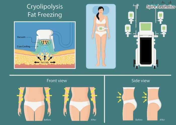 Image of diet and fat freezing combined for best results for Spire Aesthetics Hassocks
