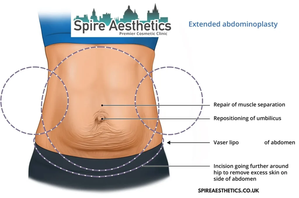 Understanding Loose Skin After Gastric Band Hassocks Surgery and HIFU Treatment