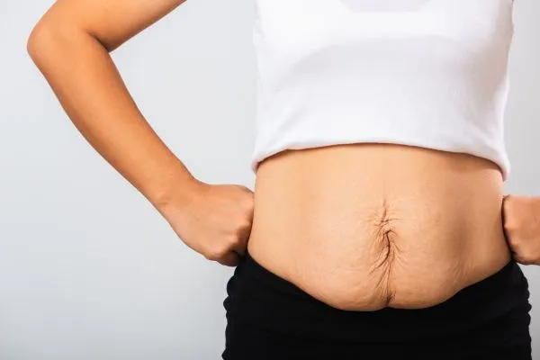 Image of a woman's stomach after weight loss with sagging skin following a gastric band Hassocks