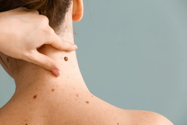 skin blemish removal Hassocks treatment