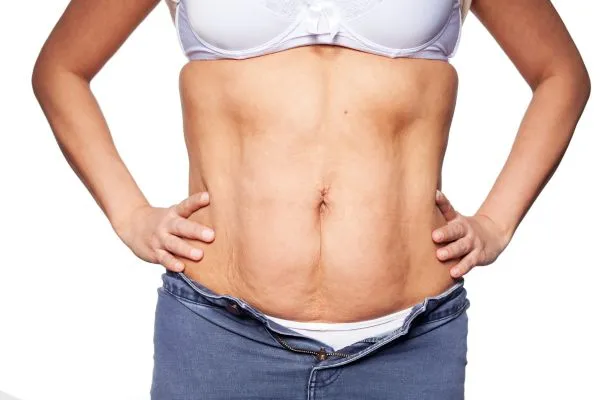 sagging skin on woman's stomach after weight loss injections Hassocks