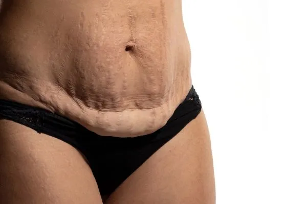 Image of womans stomach after weight loss injections Hassocks showing saggy skin